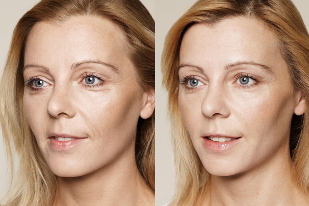 Experience before and after using intenskin cream by Valerie